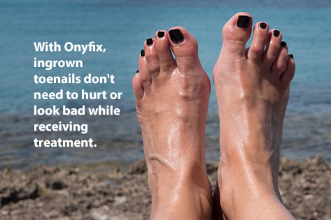 onyfix