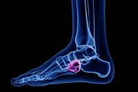 Cuboid Syndrome and Lateral Foot Pain